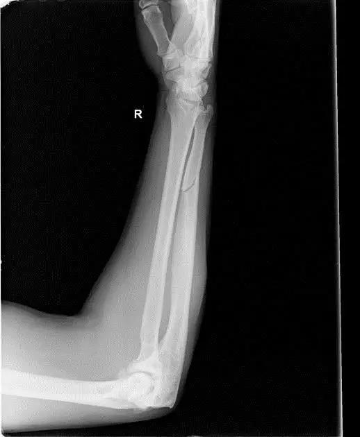 特殊骨折类型,特殊骨折体征