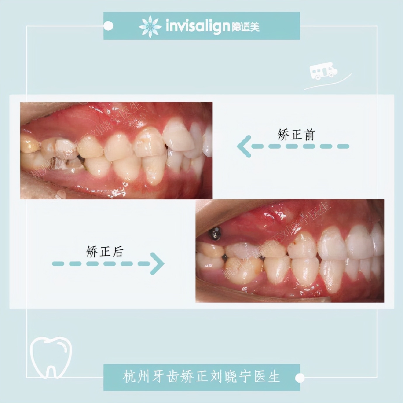 矫正牙齿如何改善露龈笑,矫正牙齿能够改善露龈笑吗