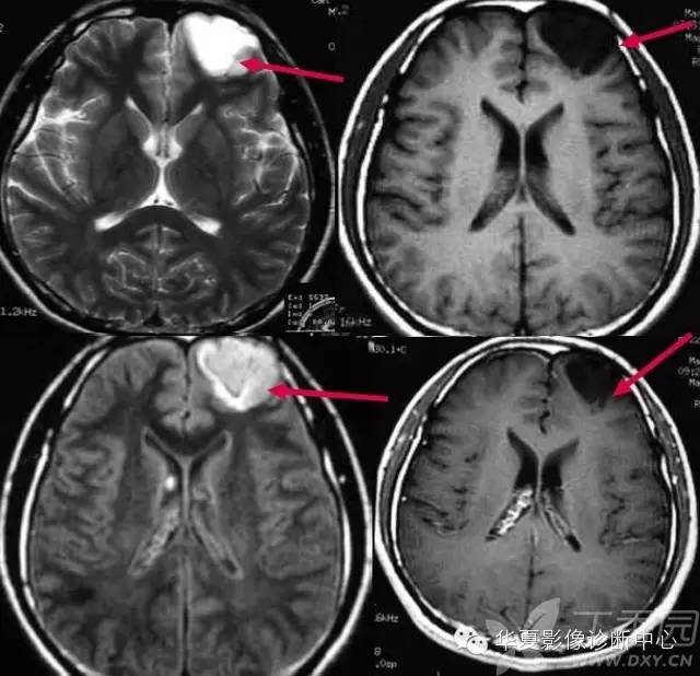 神经系统解剖及定位诊断视频,神经系统影像解析