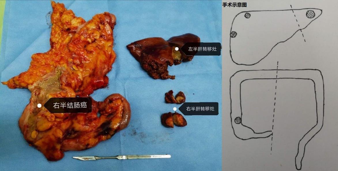 哈尔滨肿瘤医院结直肠癌行家,哈医大二院切胃手术