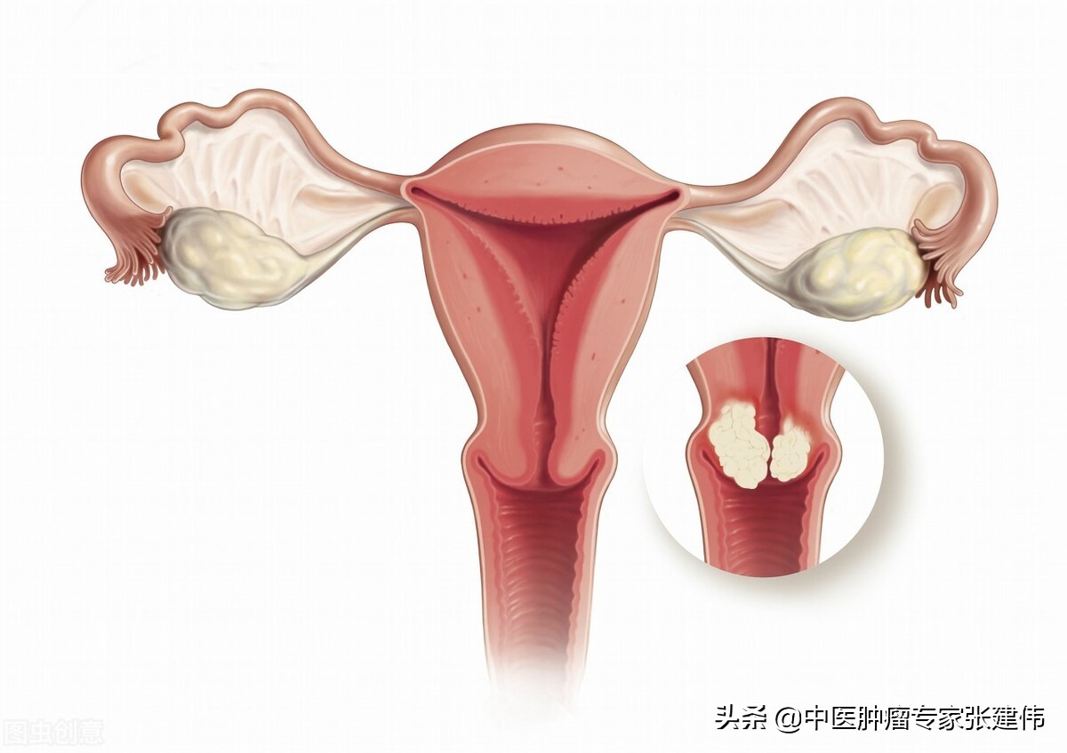 宫颈癌病人tct报告单,tct检查宫颈癌的报告单图片