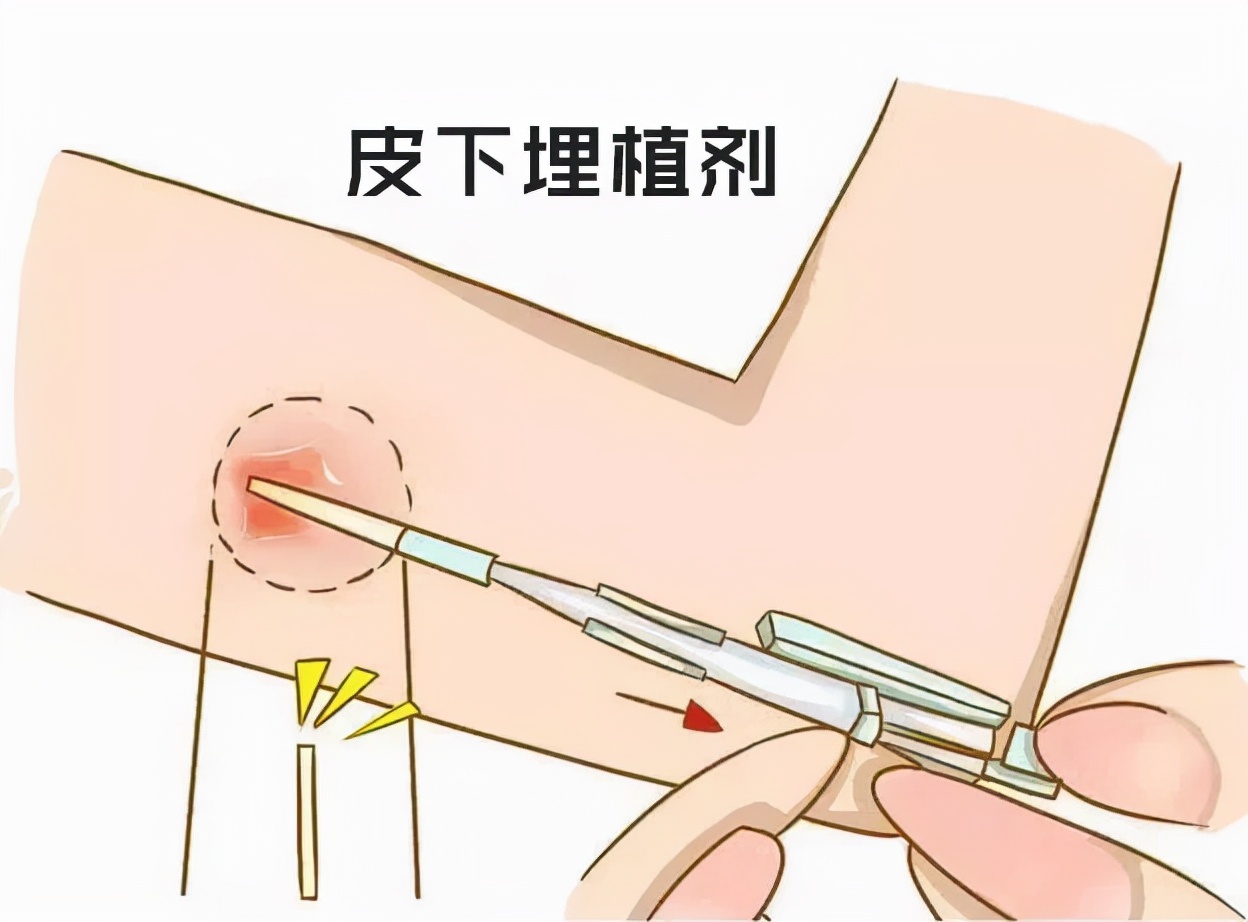 世界避孕日必备十大技巧,世界避孕日主题
