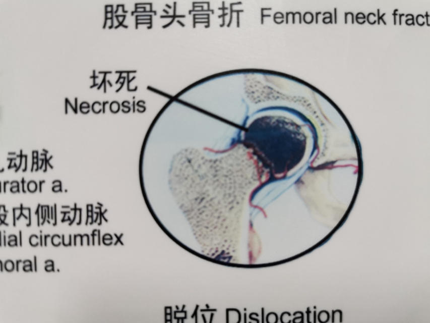 老人摔伤股骨头骨折咋办,老年人摔倒致股骨颈骨折如何处理