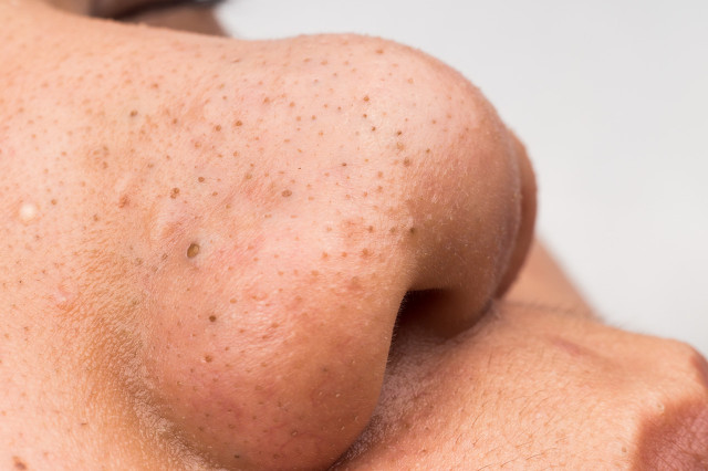 鼻子容易长黑头最有效的缓解方法,吸黑头神器跟黑头说拜拜