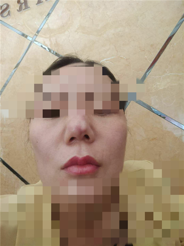 女子居民楼里整容结果成畸形：想死的心都有，老公现在见我就烦