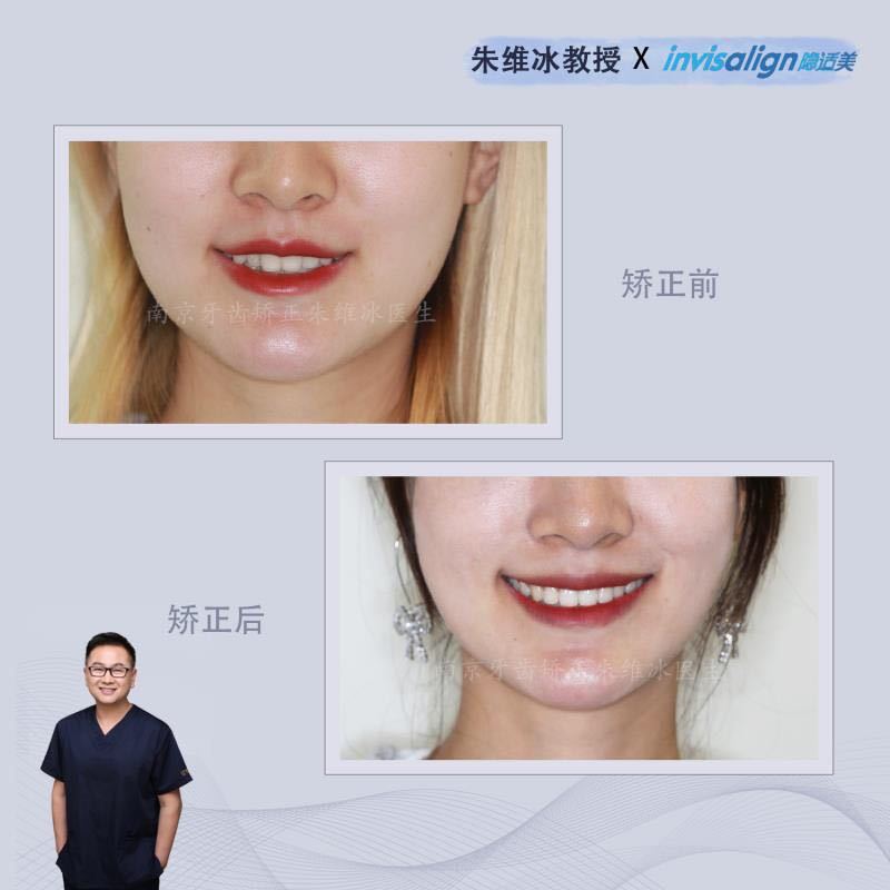 牙齿重度拥挤不拔牙正畸告捷案例,南京牙齿矫正舌侧