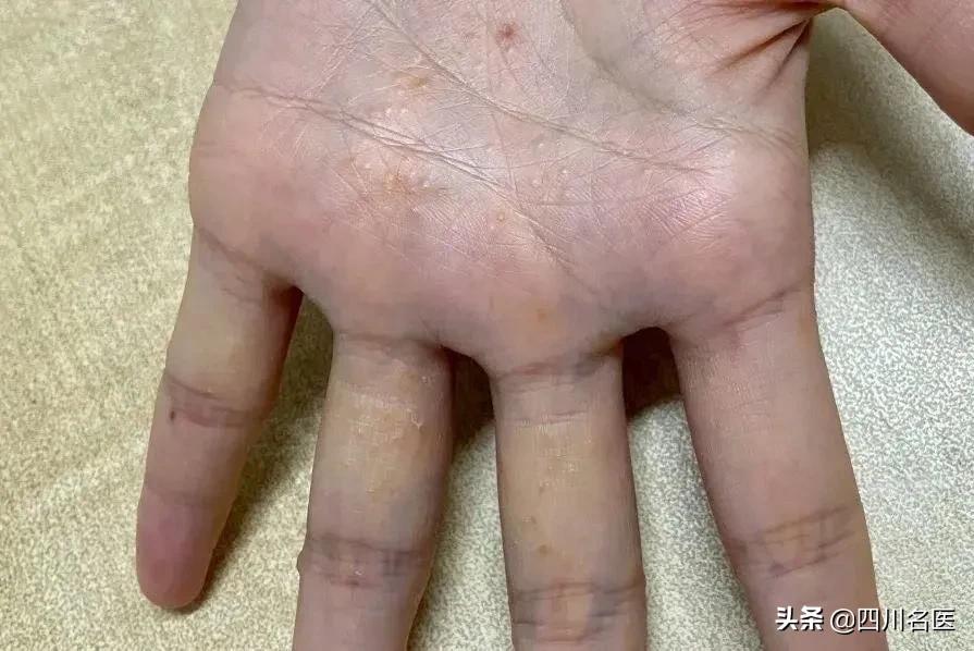 夏天手指长水疱疹怎么办,手上出现大面积的水泡很痒怎么办