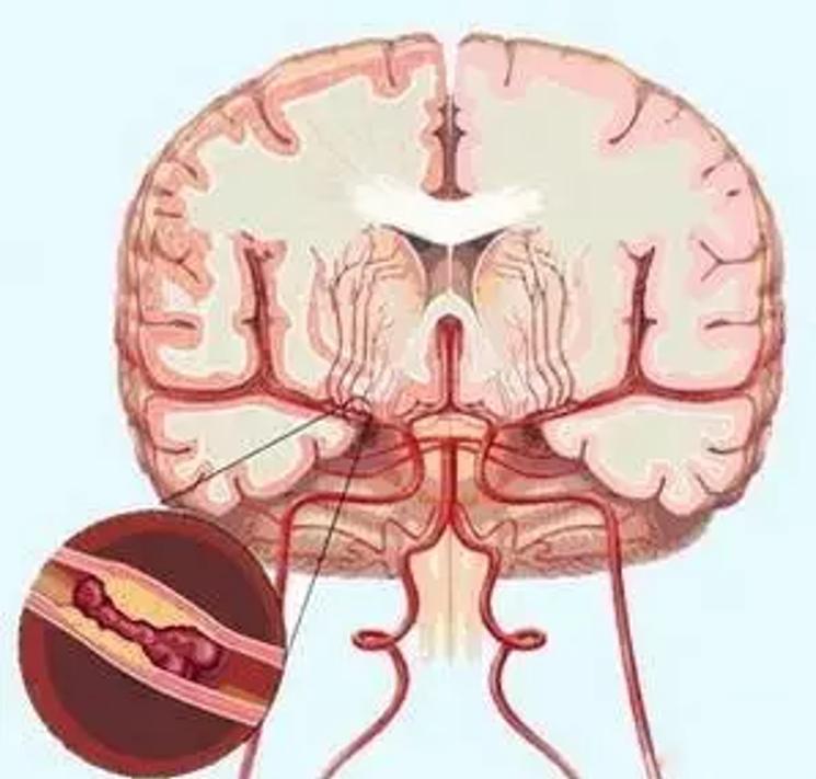 臭氧血疗法对脑梗有用吗,臭氧疗法脑梗塞