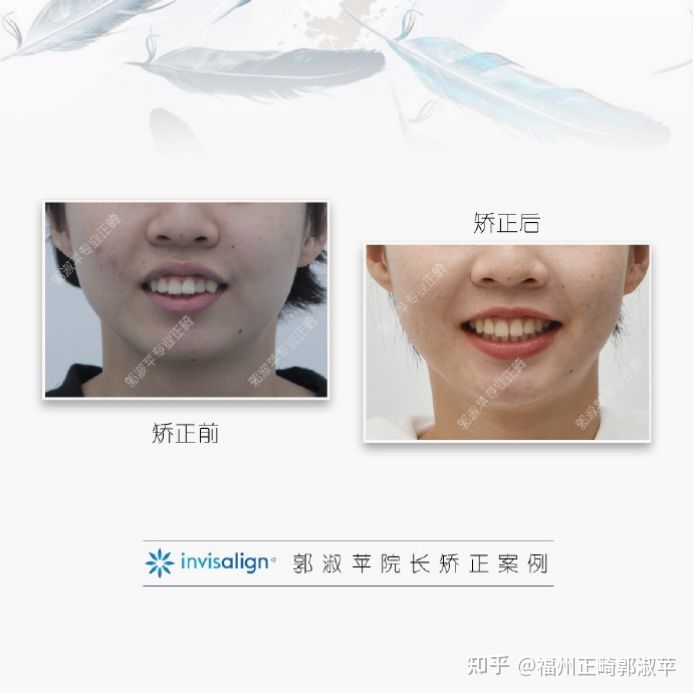 牙齿龅牙矫正过程全记录33岁,大龅牙牙齿矫正告捷案例和费用