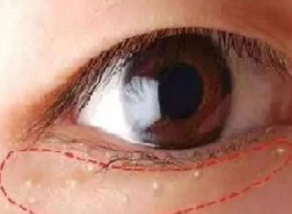 长脂肪粒真的是眼霜问题吗,长脂肪粒是不是眼霜的错