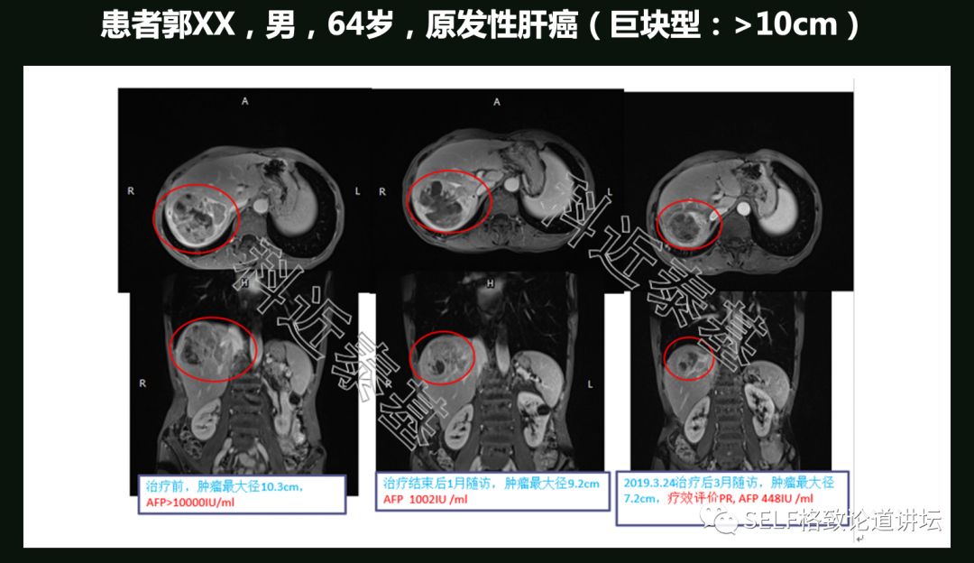 这个装置告捷辅助我国两弹爆炸，现在它能治疗肿瘤