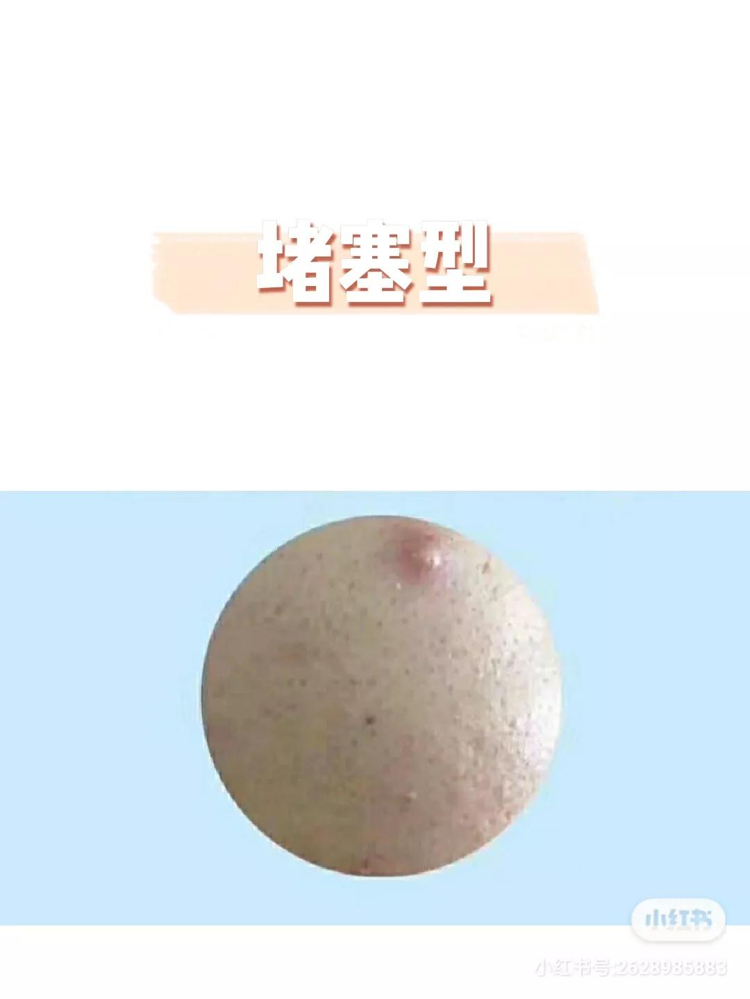 毛孔粗大全搞定这些知识要牢记,如何分辨毛孔粗大类型及改善毛孔