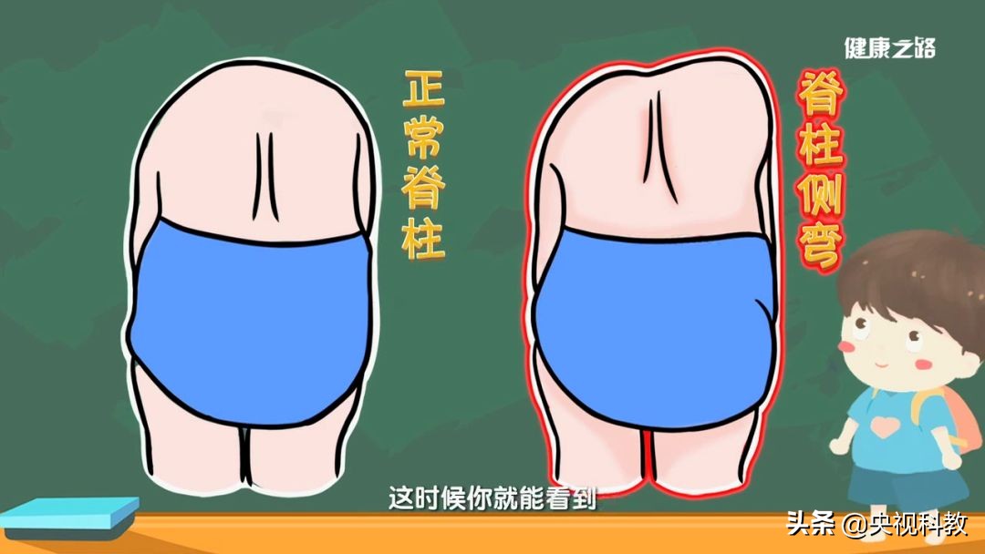小孩驼背怎么矫正过来,孩子驼背能够按回去吗