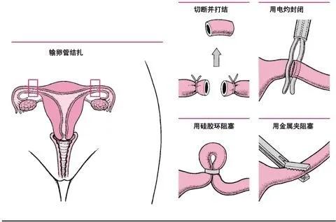 男女结扎扎哪里,男女结扎优劣势对比费用