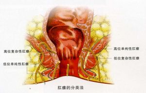 喝酒对痔疮和肛瘘的危害,比痔疮还严重的是什么病