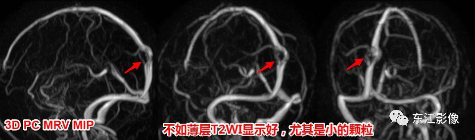 头颅mri扫描影像哪里找,头颅影像mra详细解说