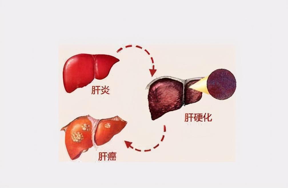 行家讲坛肝硬化恶化的症状表现,肝硬化引起肝衰竭怎么办