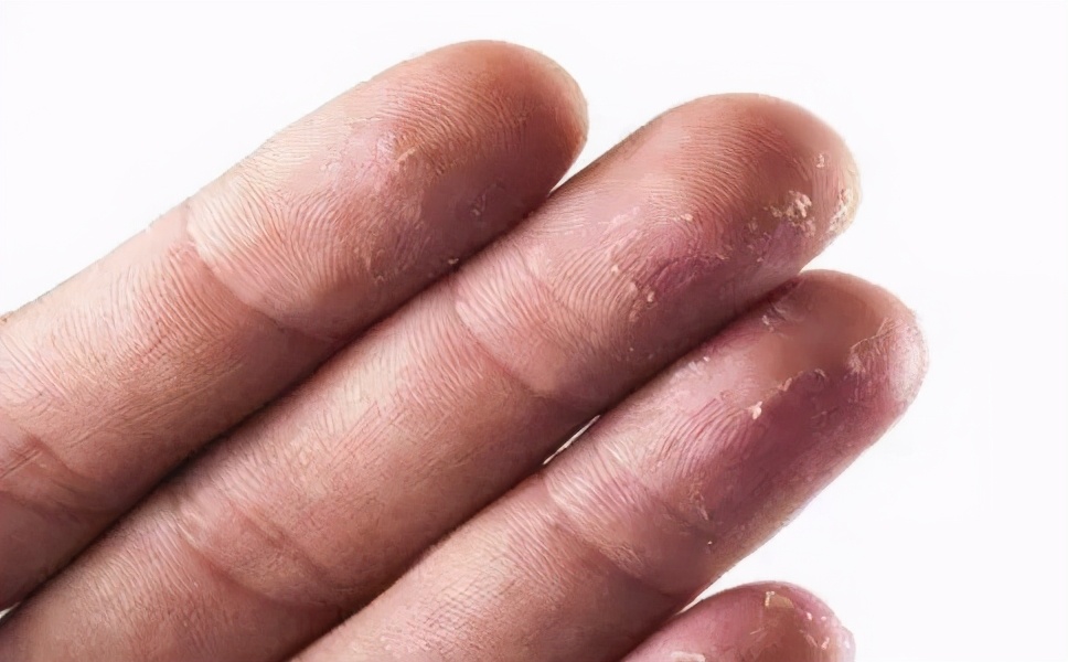 手干手脱皮有什么好办法吗,手脱皮是因为上火吗