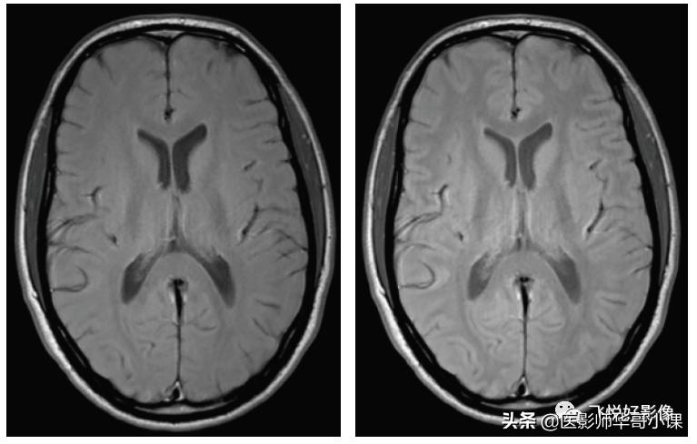 飞利浦磁共振序列参数解读,飞利浦磁共振波谱成像扫描技术