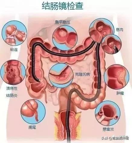 胃肠镜检查前后的注意事项,肠镜检查前后的注意事项是什么