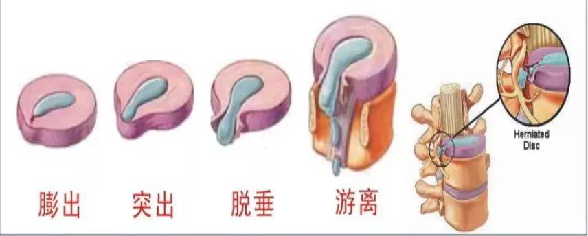 腰疼腿不疼会是椎间盘突出吗,椎间盘突出引起的腰痛怎么治