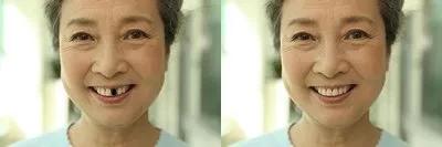 缺一颗上牙在边上镶活牙行吗,单颗牙缺失一个月不补能够吗