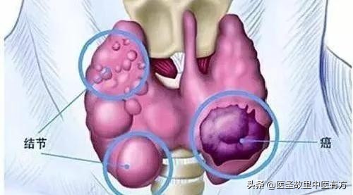甲状腺结节有可能瞬间变成癌吗,甲状腺结节两年后不见了