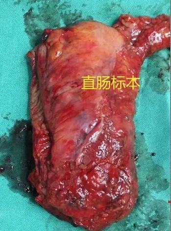 县中医院首例腹腔镜手术圆满告捷,直肠癌腹腔镜手术告捷案例