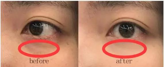去眼纹去黑眼圈用什么方法,去眼袋眼纹公认最好用的土方法