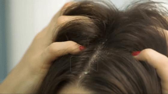 头屑的原因与处理方法,皮肤病头屑过多怎么去根