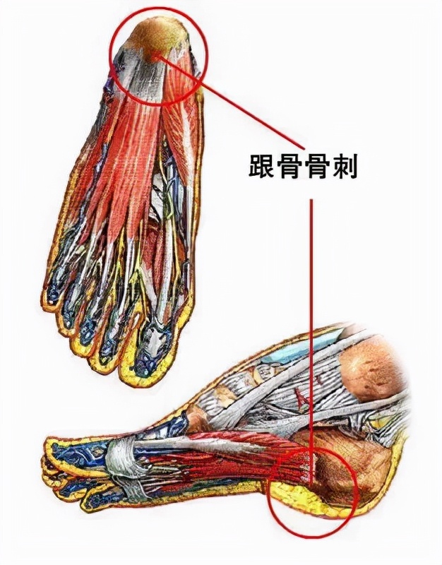 跟骨骨折和足跟骨刺哪个严重,足跟骨刺走路疼痛该如何治疗