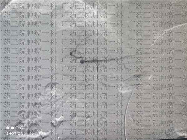 肺癌骨转移中药治疗告捷案例,肺癌骨转移中医怎么治