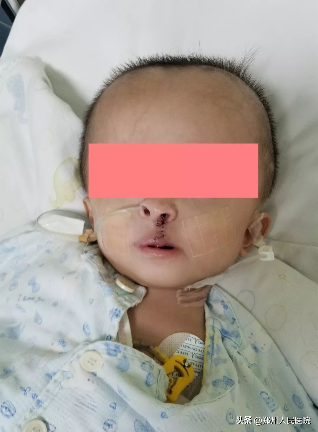 唇裂修复前后对比照,唇裂修复的全过程