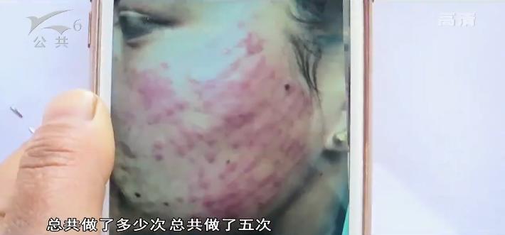 去除唇周黑在医院花多少钱,医院人员说不能够退款怎么办