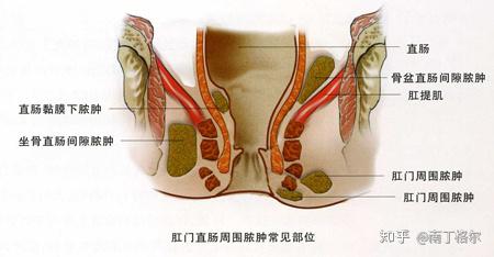 肛周脓肿低位和高位的区别,有一种病生不如死咽喉炎