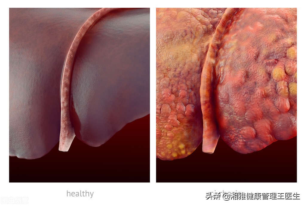 肝癌患者常见的三个症状需注意,如果患了肝癌会出现什么常见表现