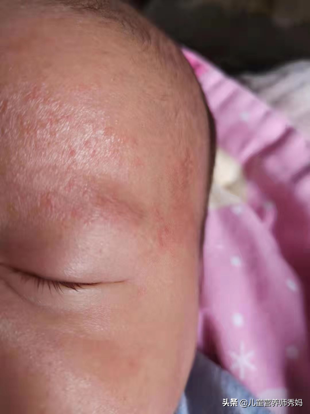 宝宝湿疹怎么办？实践证明这样处理最有效