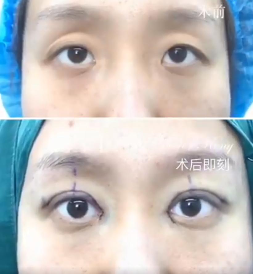 凹眼皮合适做双眼皮吗,眼窝凹陷眼睛突双眼皮不明显