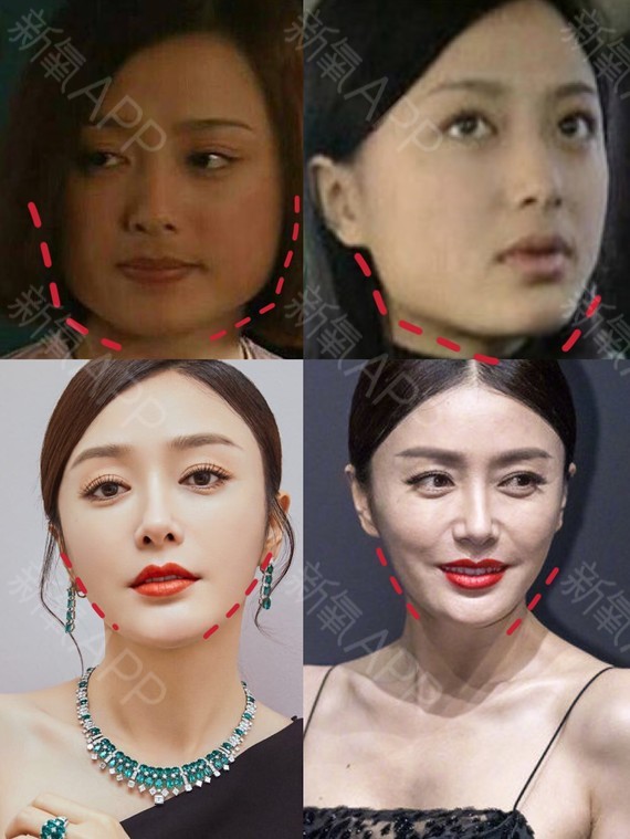 哪些明星整容后遗症越来越严重,整容明星后遗症对比图片
