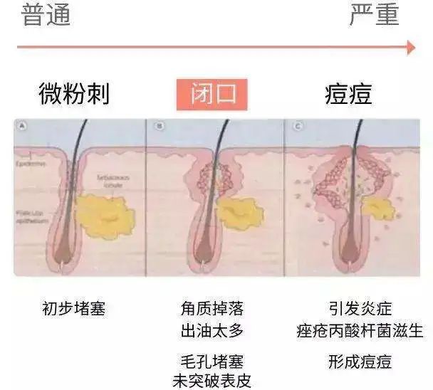 挤不出来的粉刺是什么,挤不出来的闭口自己能消失么