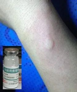 青霉素能够治哪些病,青霉素用药需要注意什么