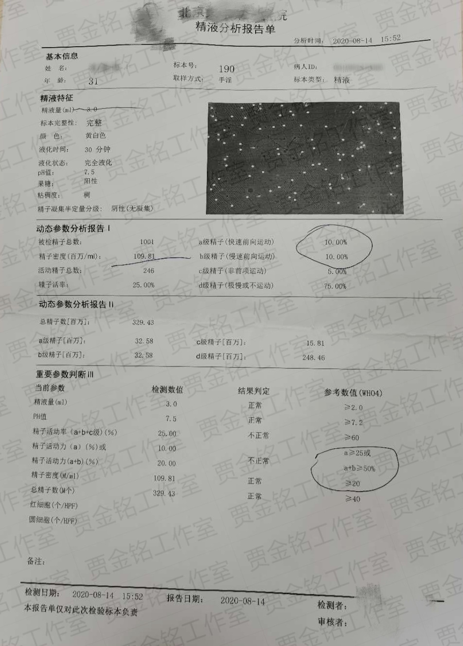 弱精子症患者备孕两个月的治疗精液检查，很开心回家能够要宝宝啦