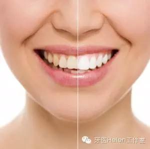 Helen齿科中心——全瓷贴面让你明眸皓齿不是梦