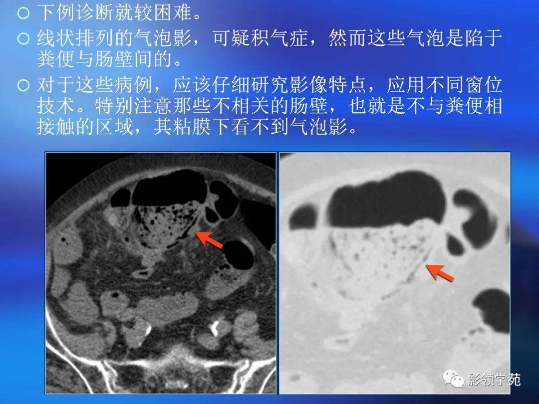 肠道内壁增厚,肠道扩张ct表现