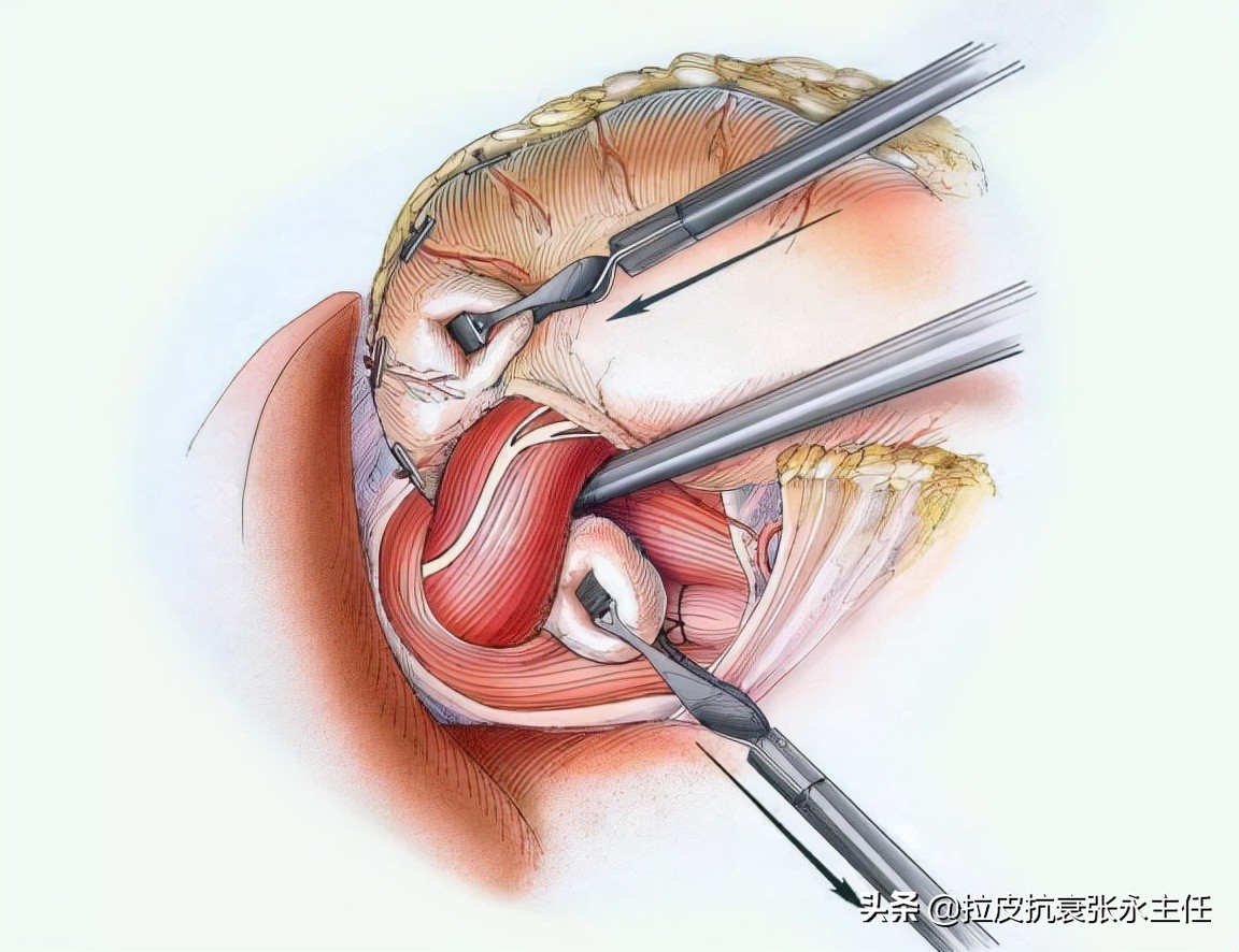 内窥镜小切口面部除皱术多少钱,微创内窥镜除皱副功能