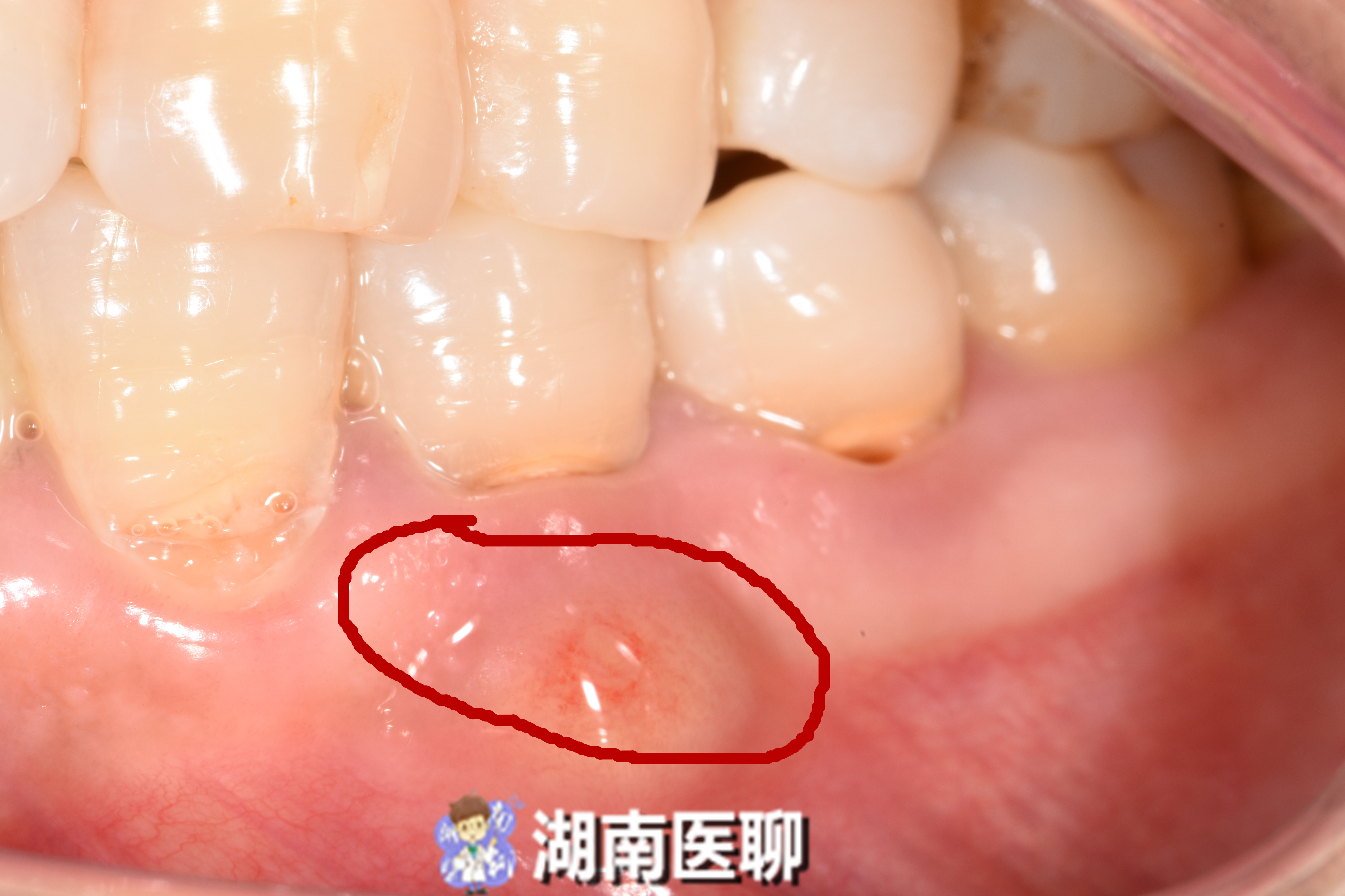 牙齿有洞很痛能够用牙痛药水吗,牙齿疼痛怎么办土方法治牙疼