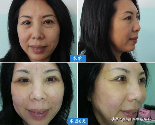 下眼皮下垂松弛能够打针吗,下眼皮睁不开是怎么回事