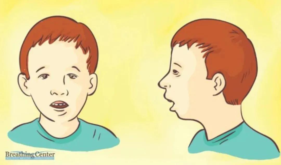 孩子腺样体打呼,儿童腺样体肥大张口呼吸怎么矫正